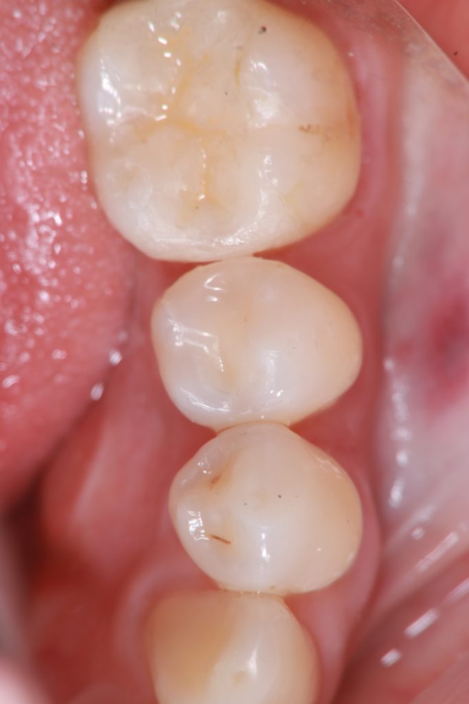 セレックにてセラミックインレーをセットしました