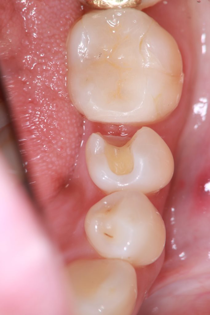 虫歯を除去して